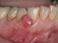 OPOMPre1 OPOMPre1